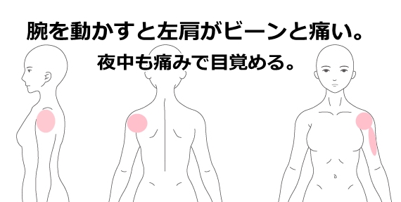 五十肩 鹿沼市の鍼(はり) ｜ ますぶちマッサージ・はり・きゅう治療院