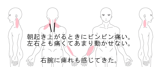 首の痛み 寝違え ムチウチ 鹿沼市の鍼 はり ますぶちマッサージ はり きゅう治療院