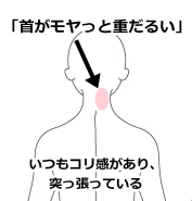 首の痛み 寝違え ムチウチ 鹿沼市の鍼 はり ますぶちマッサージ はり きゅう治療院