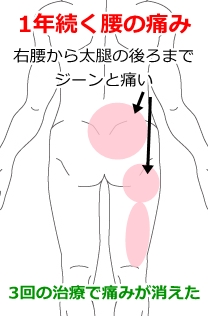 腰痛 ぎっくり腰 鹿沼市の鍼 はり ますぶちマッサージ はり きゅう治療院