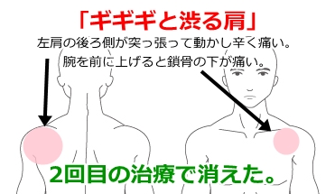 痛い 左肩 が 左肩から腕の痛みに対する７つの原因と２つの対策