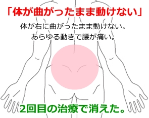 手前 ぎっくり腰 ぎっくり腰になった時の『楽になる姿勢と寝方』