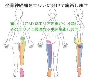 坐骨神経痛のエリア別治療