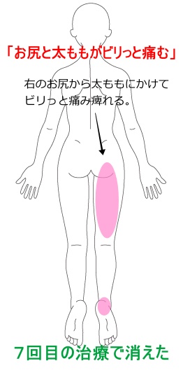 坐骨神経痛 足の痛みしびれ 鹿沼市の鍼 はり ますぶちマッサージ はり きゅう治療院