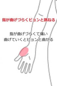 バネ指6