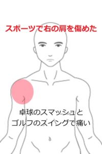 五十肩の症例13