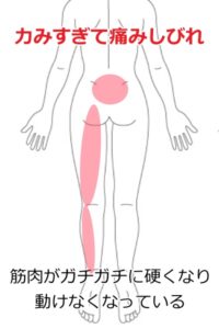 坐骨神経痛の症例31