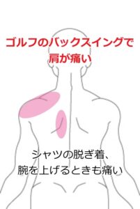 五十肩の症例14