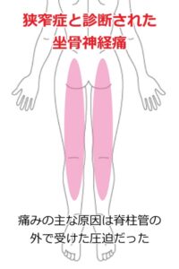 坐骨神経痛の症例33